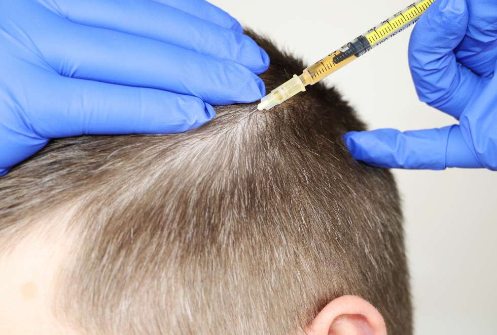 PRP injection near the scalp for hair loss treatment education at Health Builders in Annandale